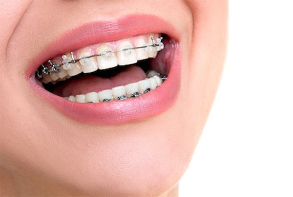 Orthodontic Treatment