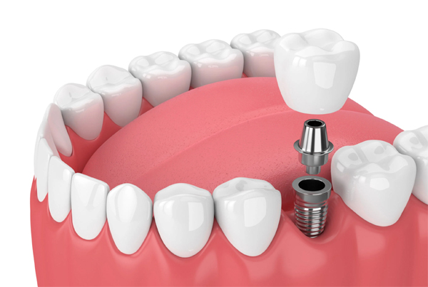 Dental Implants