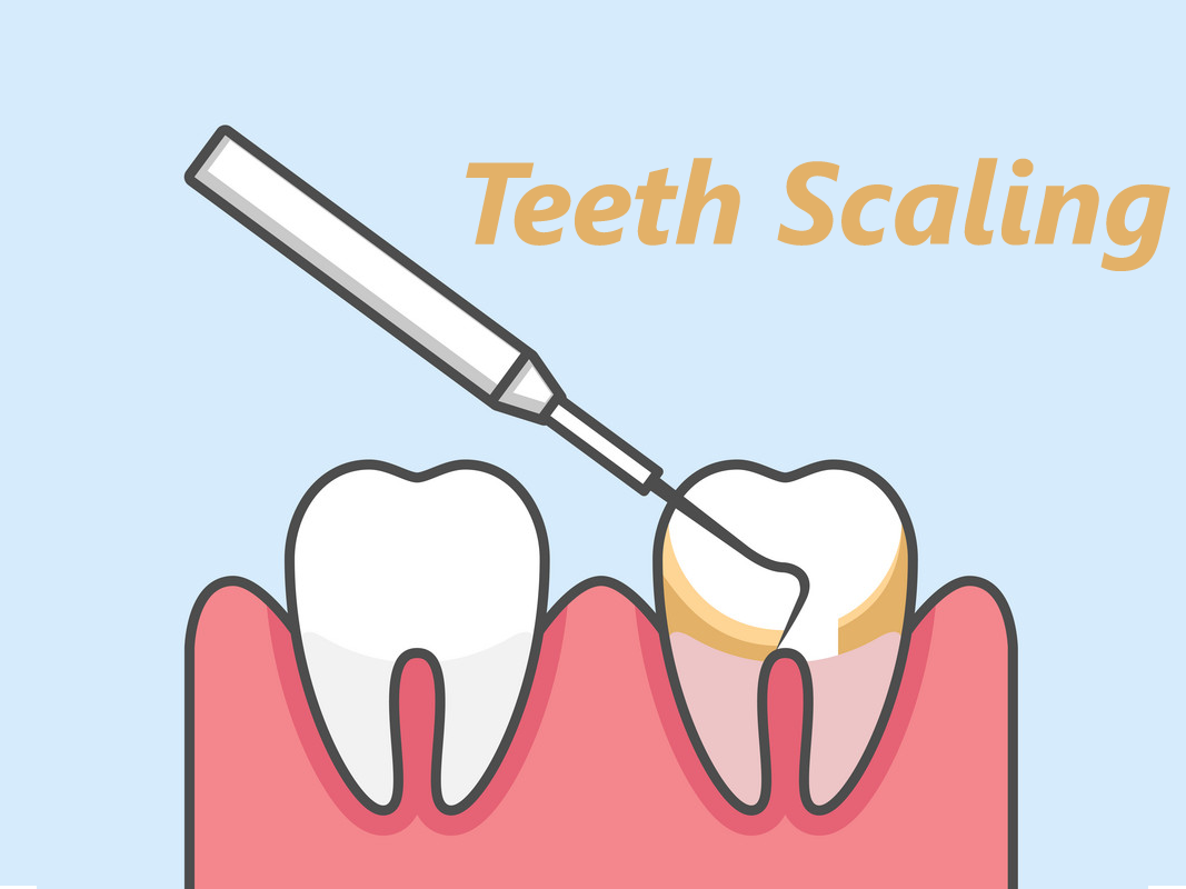 Teeth Scaling