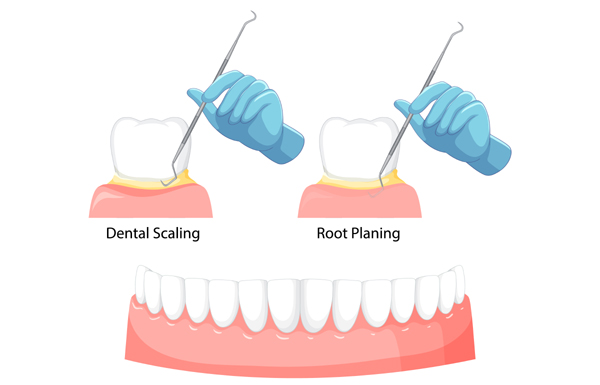 Root Planing and Curettage